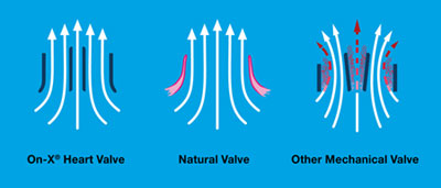 Natural design of the On-X Prosthetic Heart Valve