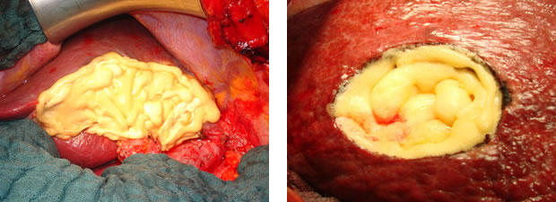 BioFoam parenchymal