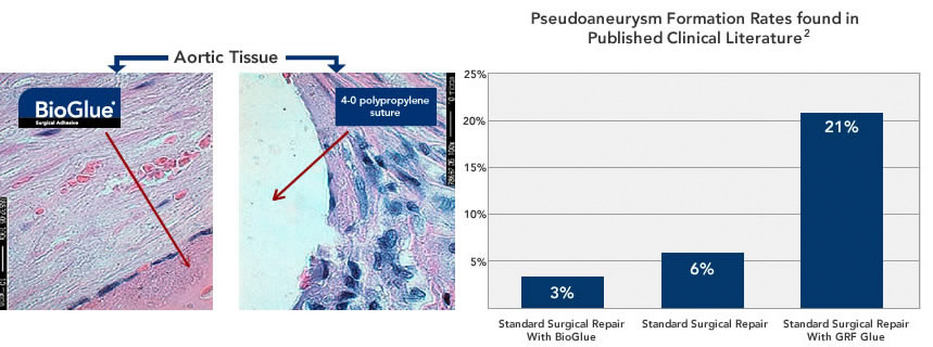 BioGlue-safety Safety of BioGlue Surgical Adhesive.