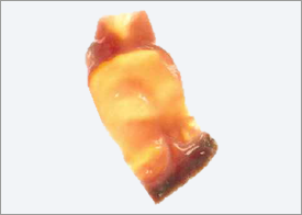 CryoPatch-SG-Pulmonary-Human-Cardiac-Hemi-Artery-Patch CryoPatch SG Pulmonary Human Cardiac Hemi Artery Patch