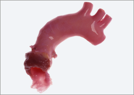 CryoValve-Aortic-Valve CryoValve Aortic Valve