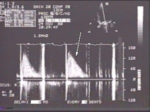 Mitral-Echo-ch_8-300x225 Mitral-Echo-ch_8-300x225