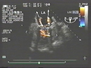 Mitral-Echo_rjets_4-300x225 Mitral-Echo_rjets_4-300x225