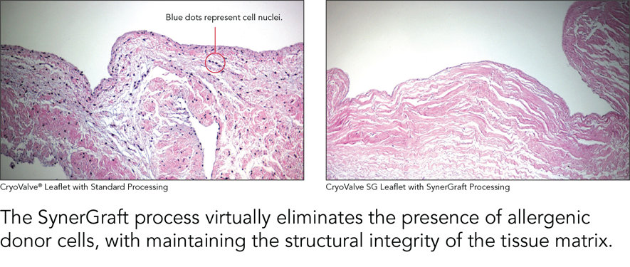 SynerGraft-process The SynerGraft Process