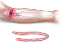 image-Infected-AV-Grafts-Remove-Infected-Graft Infected AV Grafts Remove Infected Graft