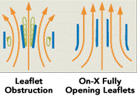 leaflet_obstruction