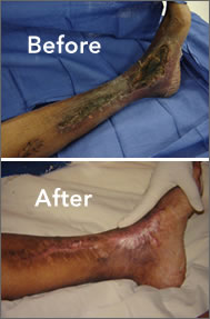 limbsalvage Limb Salvage