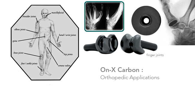 onxlti-contract-manufacturing-and-orthopedic-applications onxlti-contract-manufacturing-and-orthopedic-applications