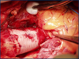perclot-coronary Right Coronary Anastomosis with PerClot