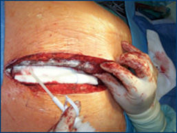 perclot-sternal Sternal Edge with PerClot