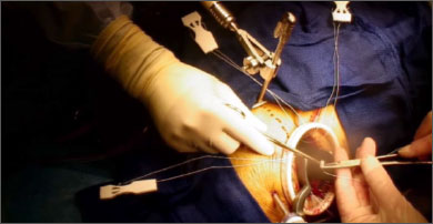 The second pledget for Chord-X Pre-Measured Loops is being advanced over suture for papillary attachment