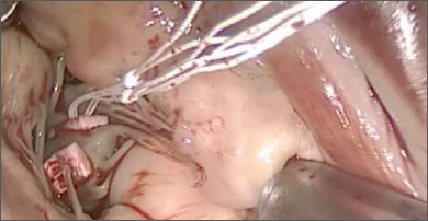 Chord-X Pre-Measured Loops have been attached to papillary (based on Chord-X Chordal Sizer measurement)