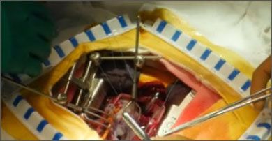 Chord-X Pre-Measured Loops may be placed in Gabbay-Frater Suture GuideTM (not required) for suture management