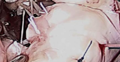 Chord-X Pre-Measured Loops attachments to leaflet with hand-tied knots are complete