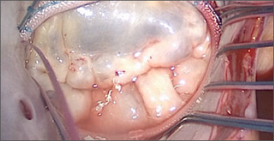Coaptation confirmed with saline test