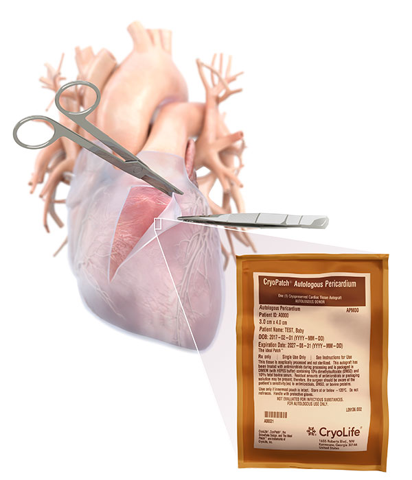 AutologousPericardium_withTools Autologous Pericardium with Tools