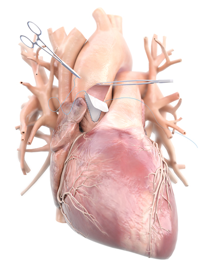 PhotoFix_AorticArch PhotoFix_AorticArch