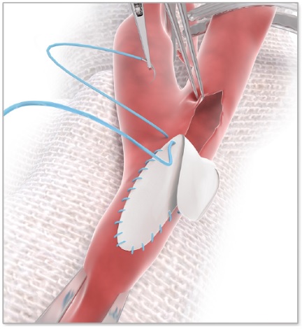 Vascular-Repair PhotoFix is indicated for Use Vascular repair and reconstruction.