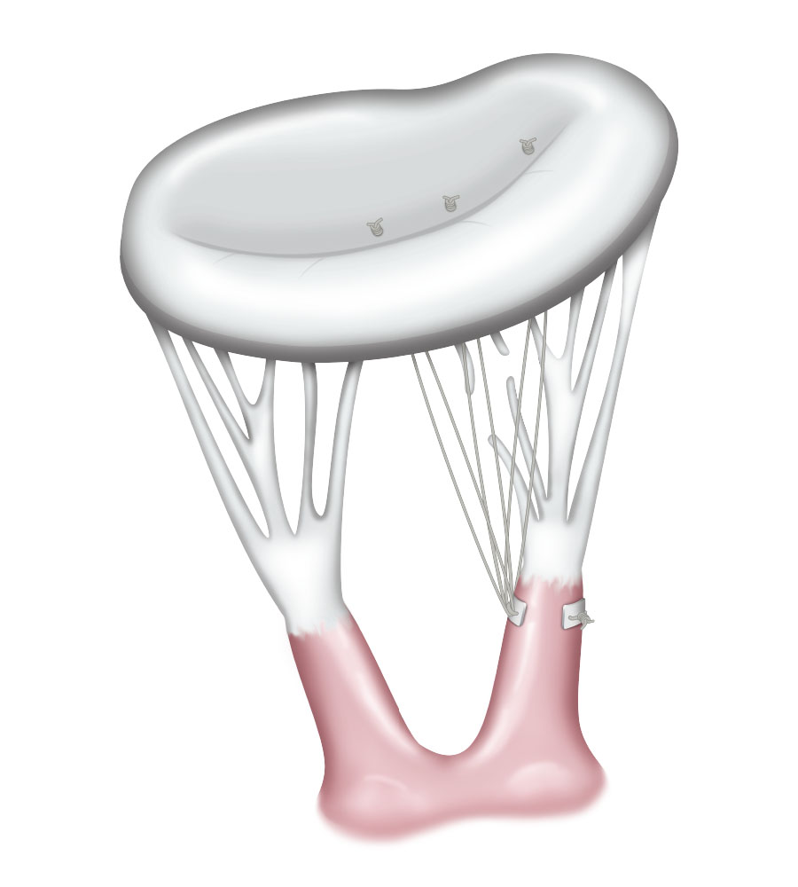 Implant-complete Implant-complete