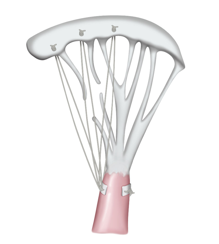 Leaflet-Attachment Leaflet-Attachment